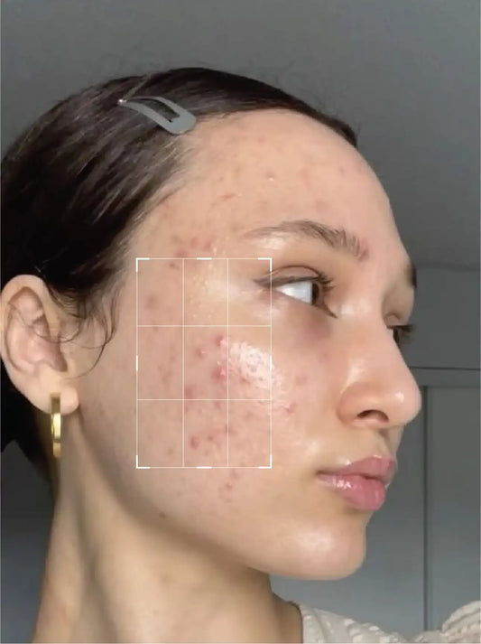 Oil Control Facewash (Tea Tree Oil with Salicylic Acid 2%)